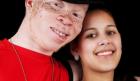 Albinism: The Gift of Gold