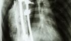 scoliosis surgery death sentence