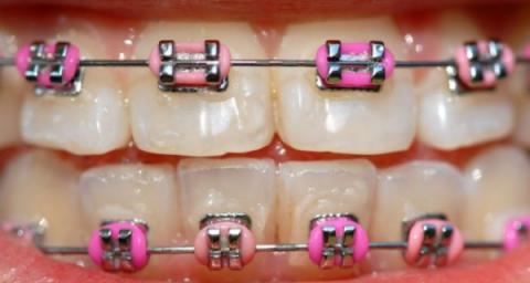 My New Braces
