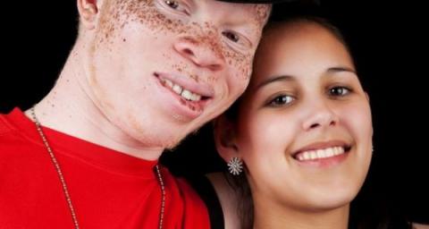 Albinism: The Gift of Gold