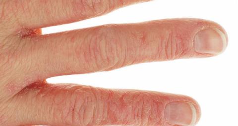 contact dermatitis hairdressing