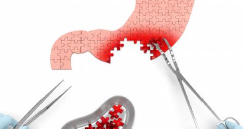 Partial Gastrectomy