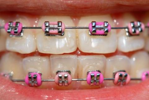 My New Braces