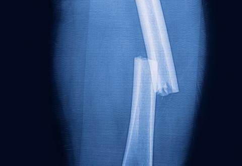 atypical femur fracture story