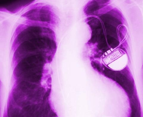 Be Still My Beating Heart: Implantable Defibrillator