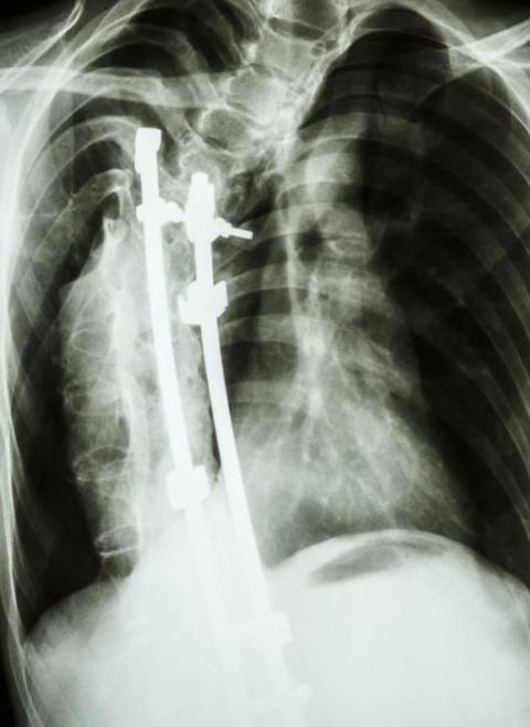 scoliosis surgery death sentence